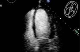 49-year-old male with low EF