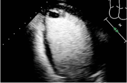 52-year-old male with chronic systolic heart failure