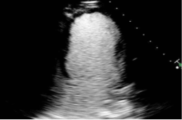 61-year-old female with CAD and left main stent