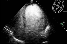 62-year-old male with bilateral extremity numbness