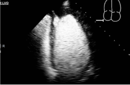 72-year-old female with radiating chest pain