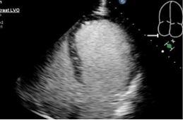 78-year-old male with CAD and HFrEF